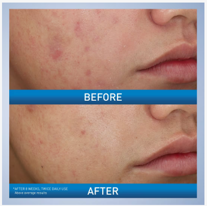 CeraVe | Foaming Cream Wash | Crema Espumosa para Acné